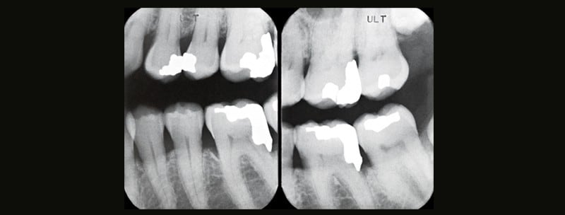 Dental X-ray showing multiple teeth with large white areas indicating existing fillings or significant tooth decay (caries) for clinical diagnosis