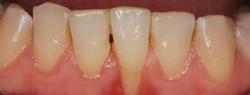 Close-up of human lower teeth and inflamed gums showing signs of periodontal disease for clinical dental care education
