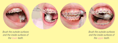 Étapes pour brosser les surfaces intérieures et extérieures des dents du haut et du bas avec des broches orthodontiques