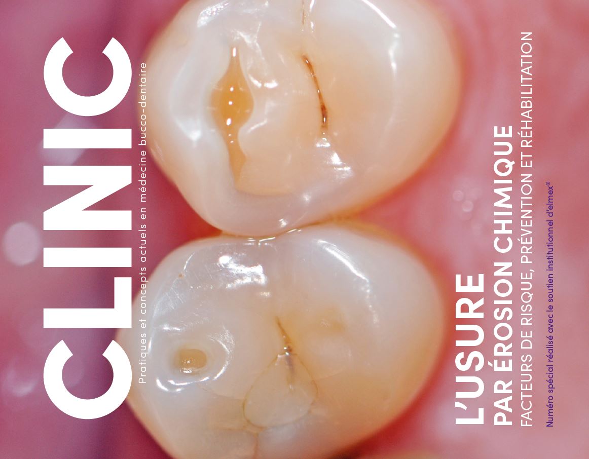 L'Usure par érosion chimique : Facteurs de risque, prévention et réhabilitation - CLINIC Octobre 2022
